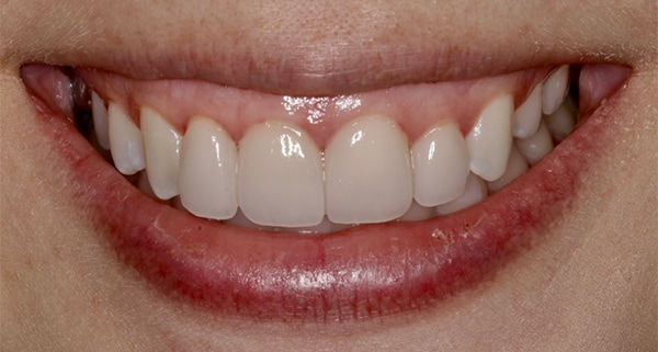 porcelain veneers after