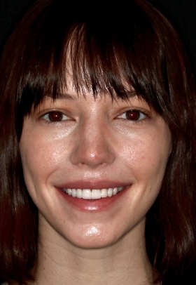 Porcelain Veneers After