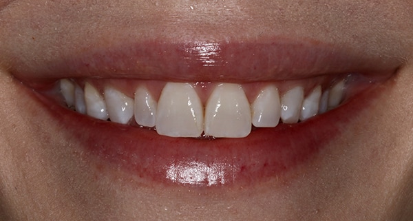 porcelain veneers before