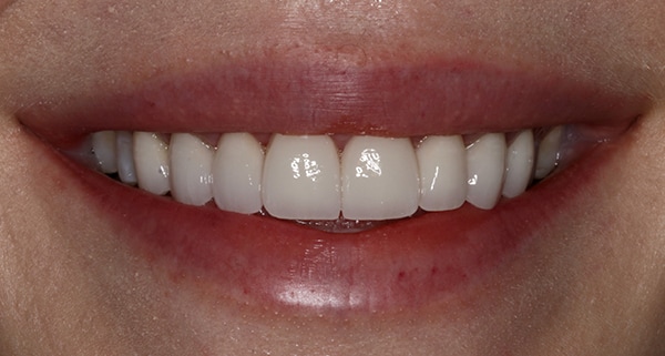 porcelain veneers after