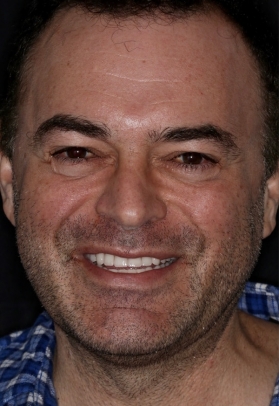 Porcelain Veneers After