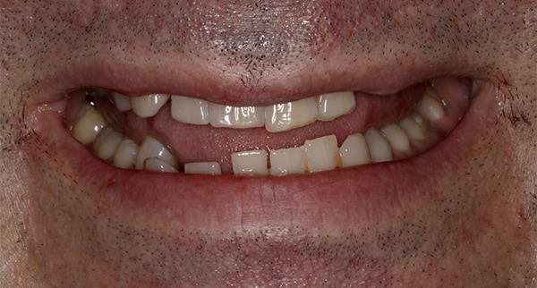 porcelain veneers before