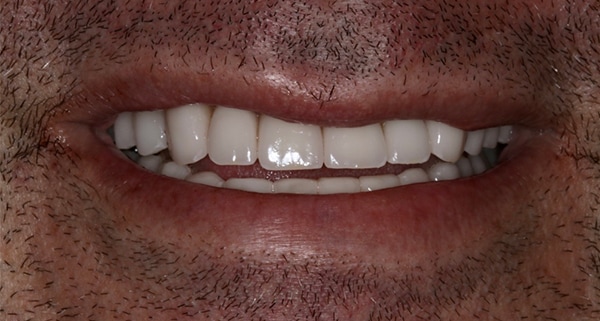 porcelain veneers after