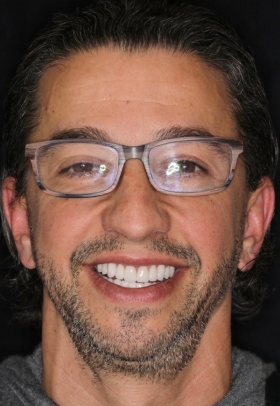 Porcelain Veneers After