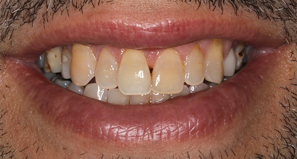 porcelain veneers before