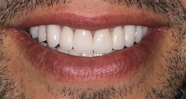 porcelain veneers after