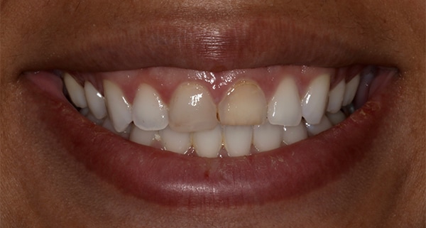 porcelain veneers before