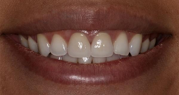 porcelain veneers after