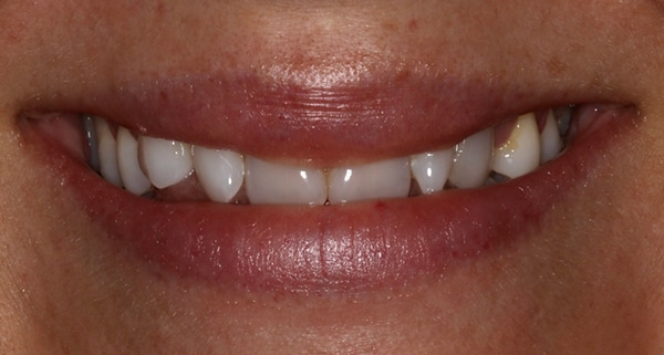 porcelain veneers before