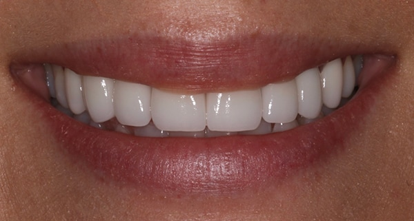 porcelain veneers after