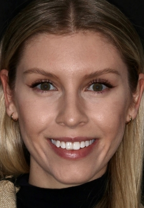 Porcelain Veneers Before