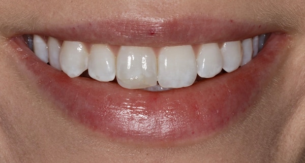 porcelain veneers before