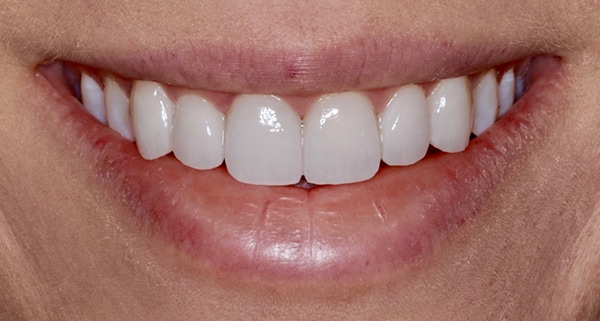 porcelain veneers after