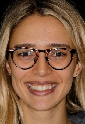 Porcelain Veneers Before