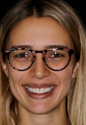 Porcelain Veneers After