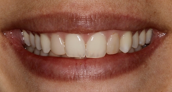 porcelain veneers before