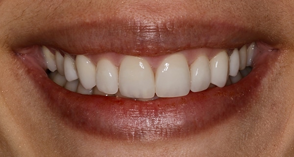 porcelain veneers after