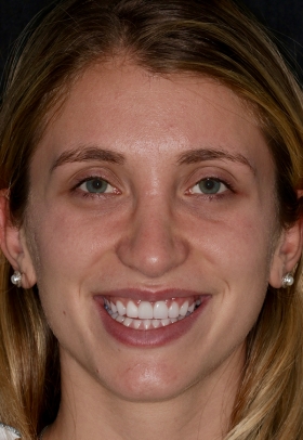 Porcelain Veneers After