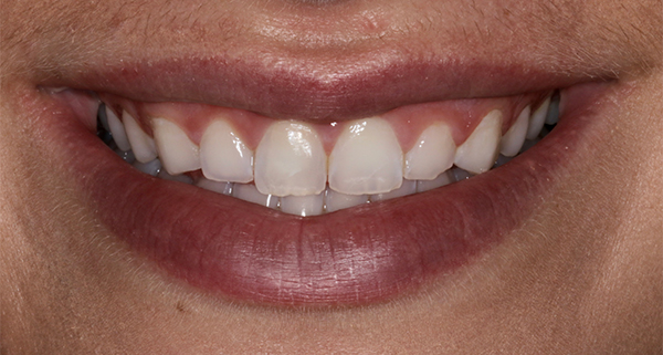 porcelain veneers before