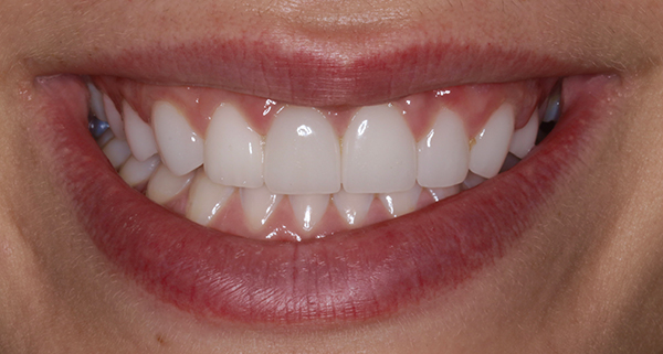 porcelain veneers after