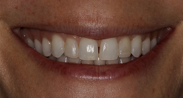 porcelain veneers before