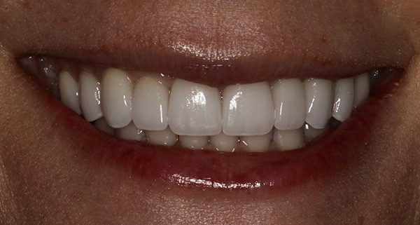 porcelain veneers after