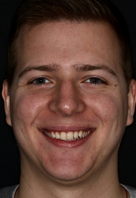 Porcelain Veneers Before