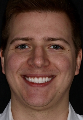 Porcelain Veneers After