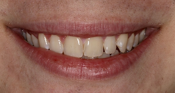 porcelain veneers before