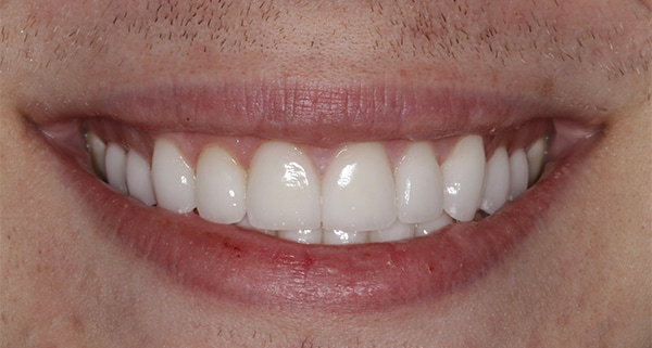 porcelain veneers after