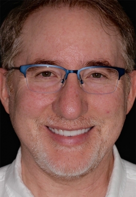 Porcelain Veneers After