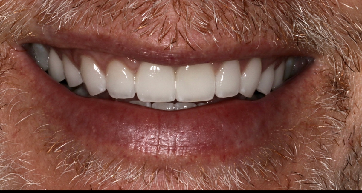 porcelain veneers after