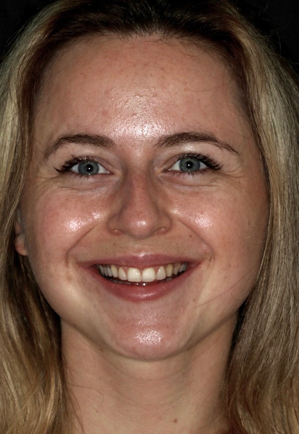 Porcelain Veneers Photos NYC - Portrait Before Women Patient 94