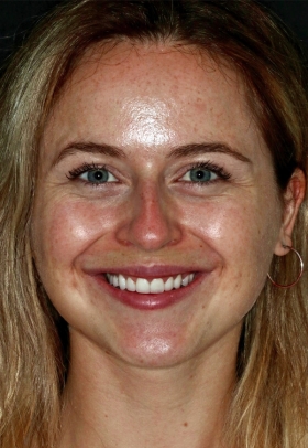 Porcelain Veneers After