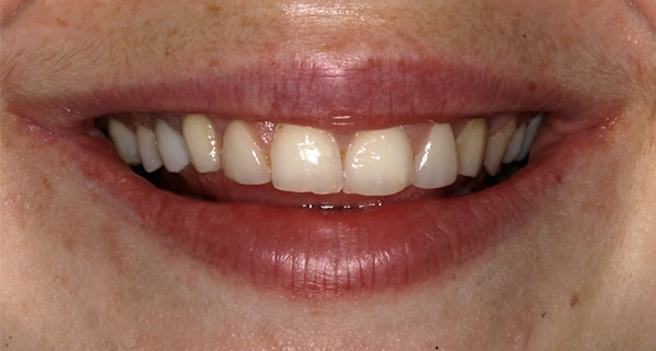 Porcelain Veneers Photos NYC - Smile Before Women Patient 94