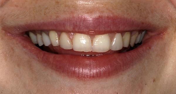 porcelain veneers before