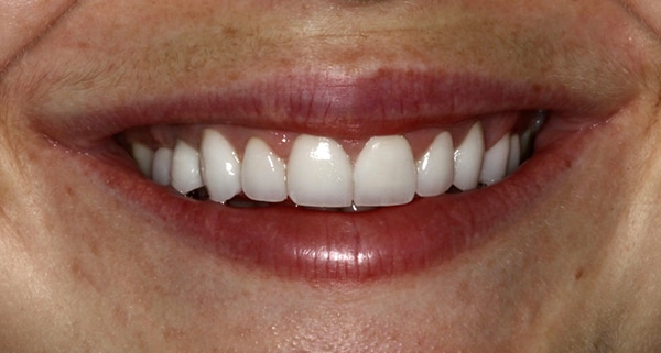 porcelain veneers after