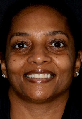 Porcelain Veneers Before