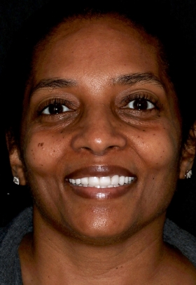 Porcelain Veneers After