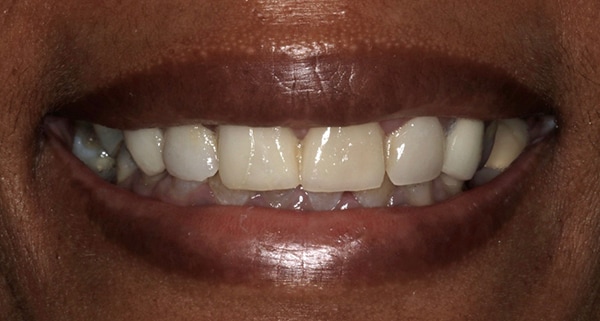 porcelain veneers before