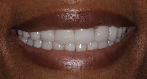 porcelain veneers after