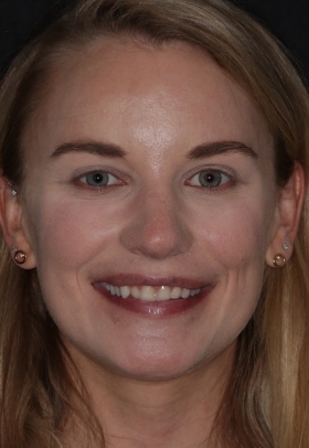 Porcelain Veneers Before