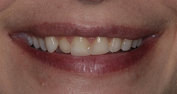 porcelain veneers before