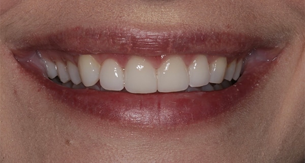 porcelain veneers after