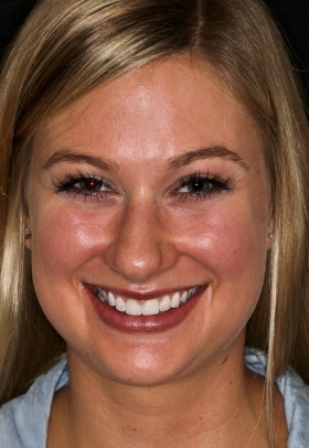 Porcelain Veneers Before