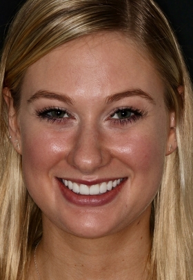 Porcelain Veneers After