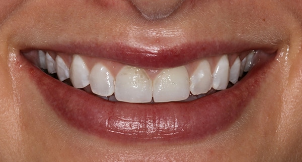 porcelain veneers before