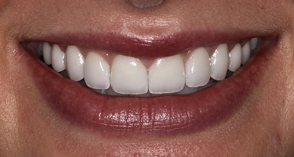 porcelain veneers after