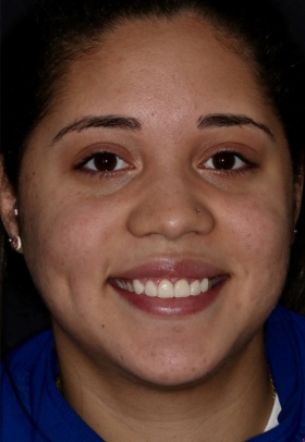 Porcelain Veneers After