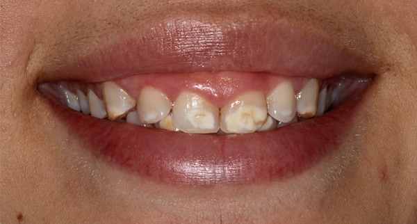 porcelain veneers before